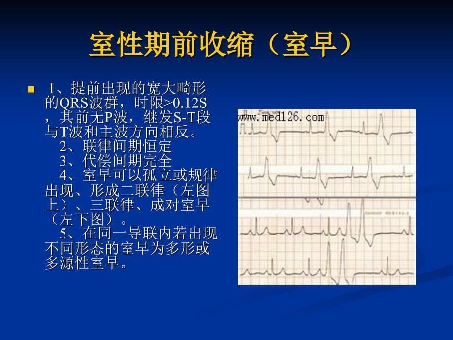 病理心电图表现_第5页