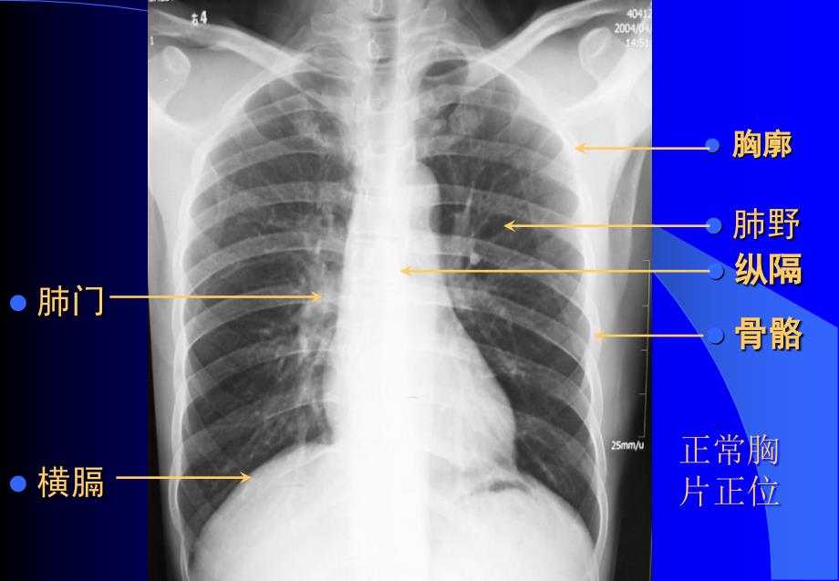 x线平片常见病变讲座文档资料_第3页