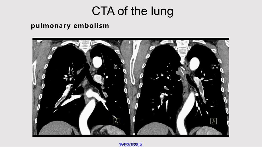 CT临床应用实用教案_第4页
