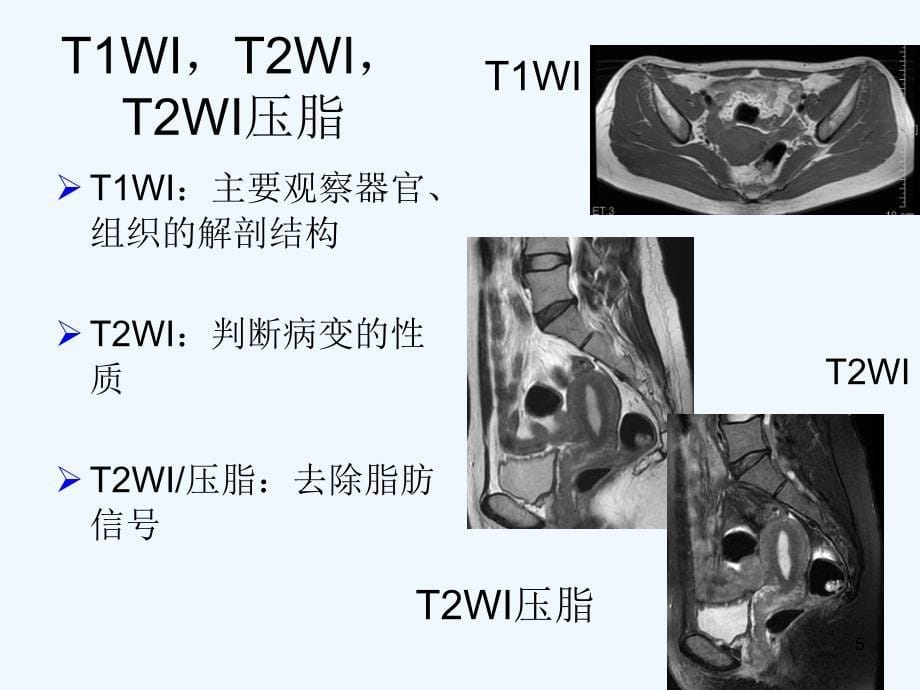 子宫疤痕与疤痕妊娠的MRI诊断_第5页