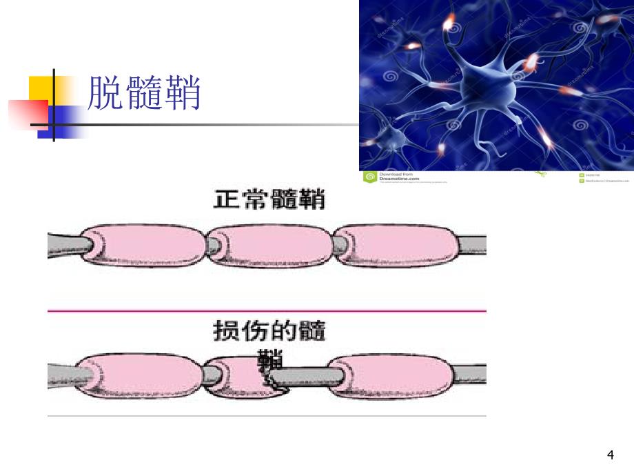 多发性硬化PowerPoint演示文稿_第4页