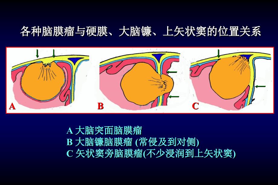 颅内和椎管内肿瘤3神经外科教学课件_第2页