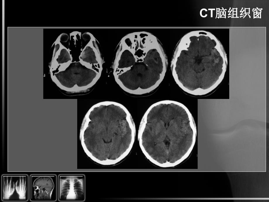 大脑动静脉畸形影像学多序列表现_第4页