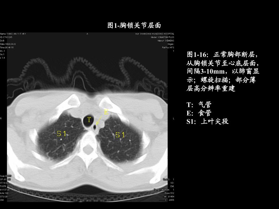 胸部ct解剖及典型病例CT征象_第1页