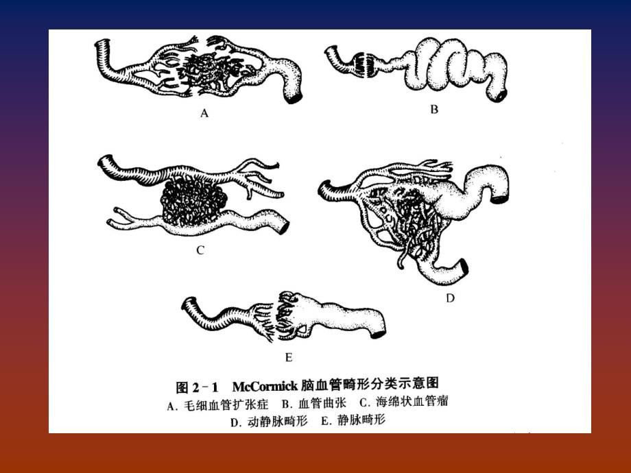 《脑血管畸形诊断》PPT课件_第5页