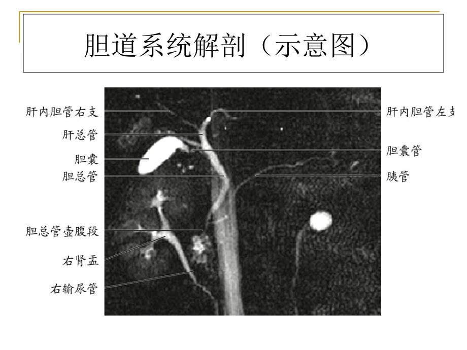 Caroli病的影像表现_第2页