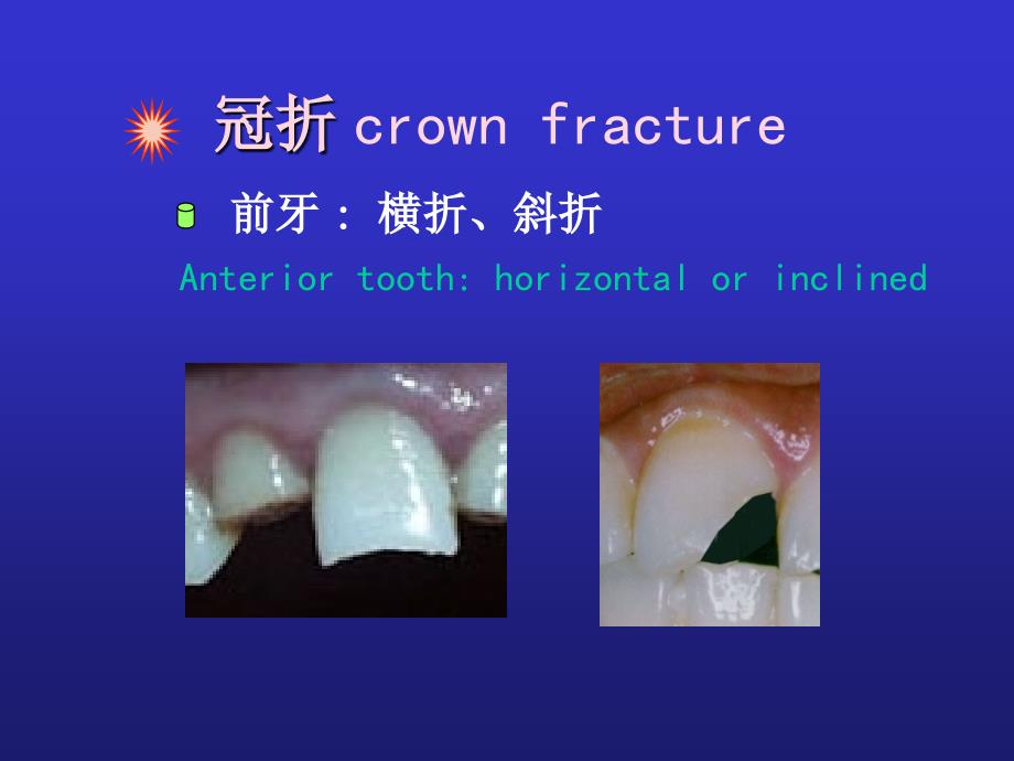 牙折的病因及治疗方法_第5页