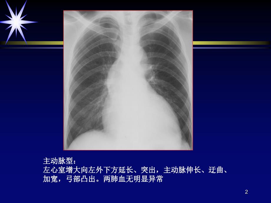 先天性心脏病课件_第2页