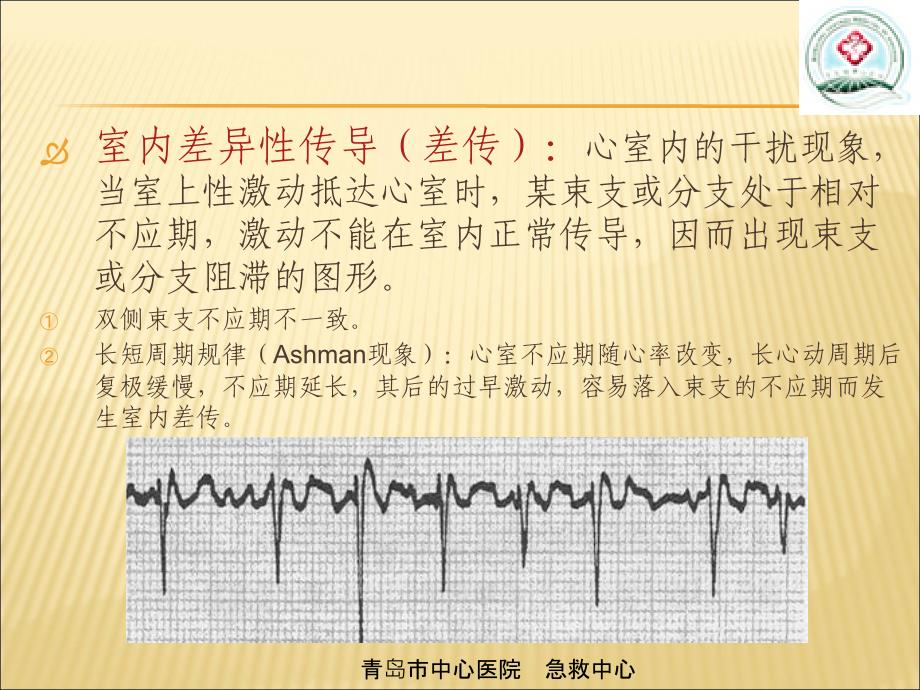 室性心动过速的心电图鉴别PPT精选文档_第4页