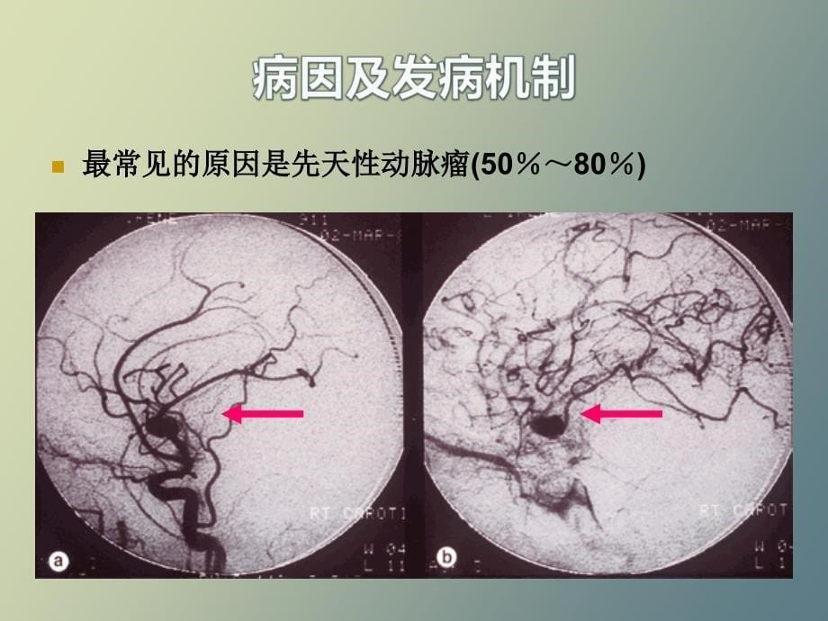 老年人蛛网膜下腔出血_第5页