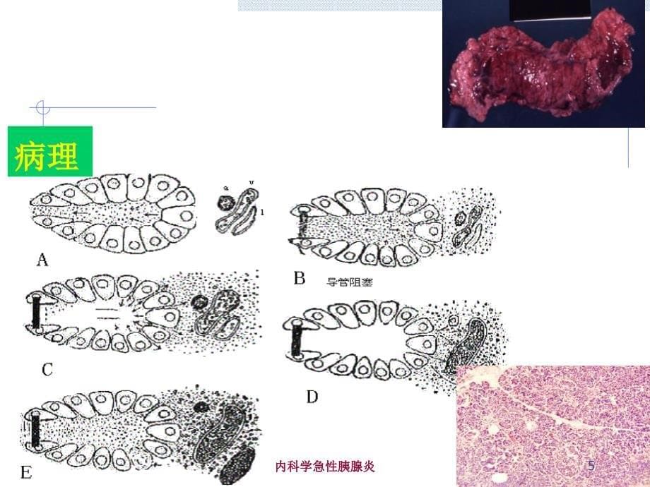 内科学急性胰腺炎培训课件_第5页