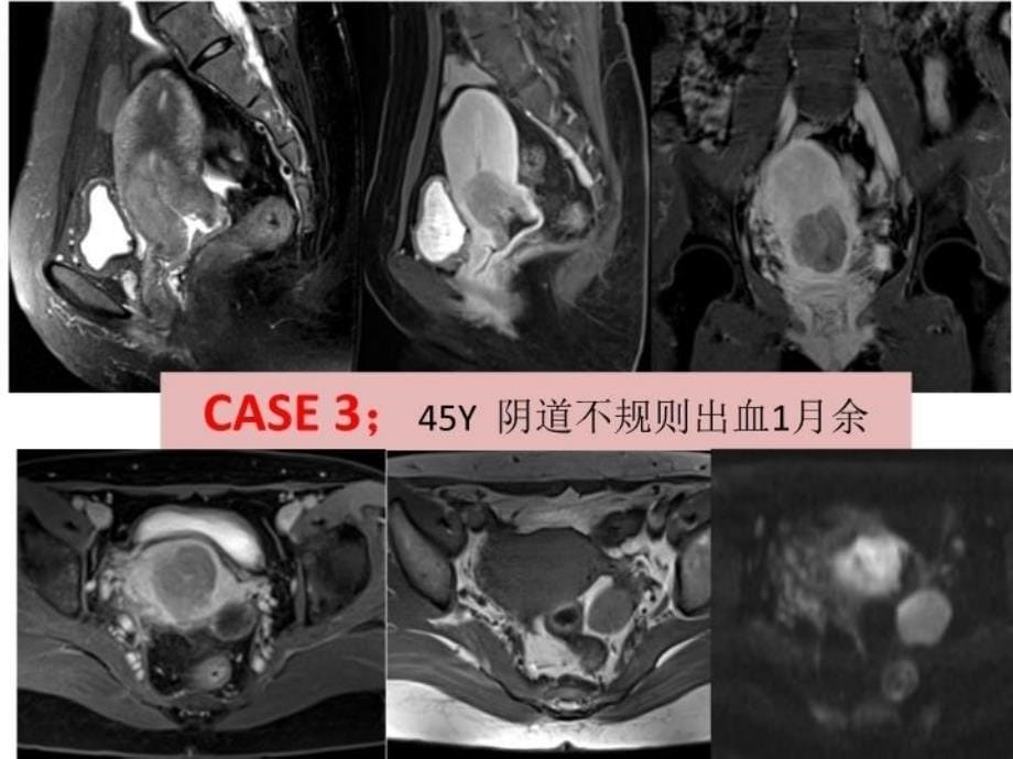 最新子宫内膜癌与宫颈癌相关解剖与影像表现二PPT课件_第5页