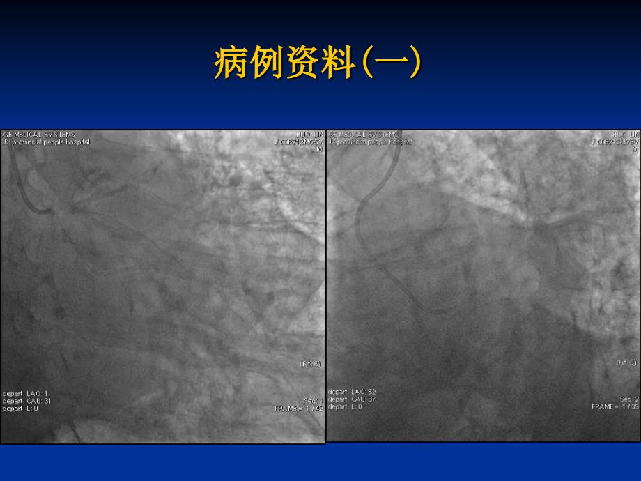 经桡动脉处理分叉病变及左主干分叉病变球囊运用技巧及策略_第2页