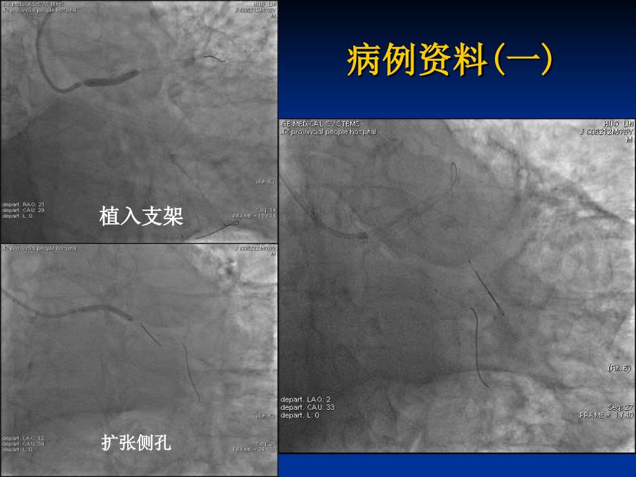 经桡动脉处理分叉病变及左主干分叉病变球囊运用技巧及策略_第3页