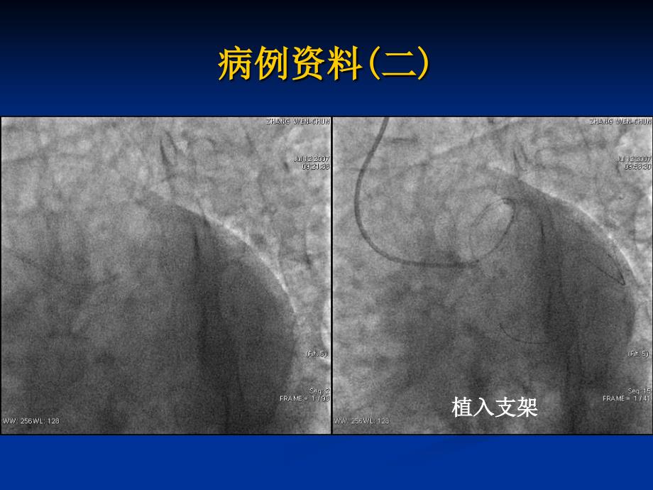 经桡动脉处理分叉病变及左主干分叉病变球囊运用技巧及策略_第4页