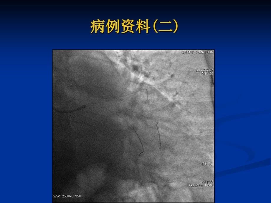 经桡动脉处理分叉病变及左主干分叉病变球囊运用技巧及策略_第5页