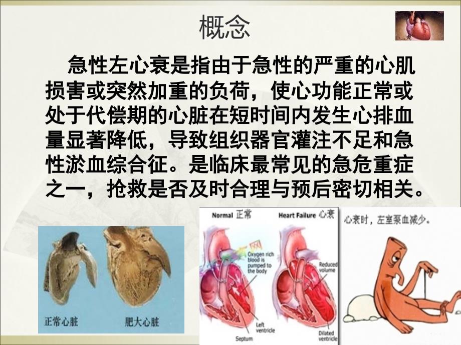 急性左心衰的急救护理ppt课件_第3页