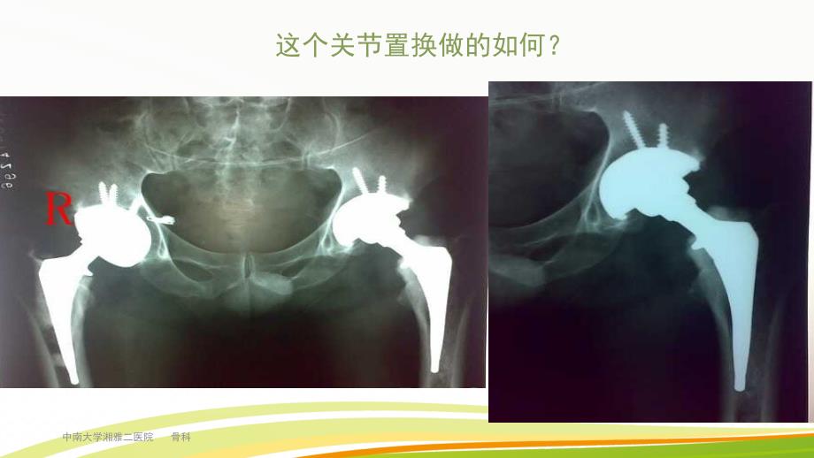 髋关节置换的X线评估PPT1250_第2页