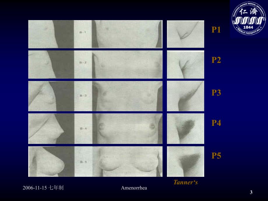 最新Amenorrhea妇产科仁济临床医院精选PPT文档_第3页
