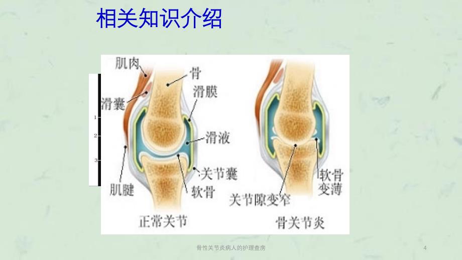 骨性关节炎病人的护理查房课件_第4页