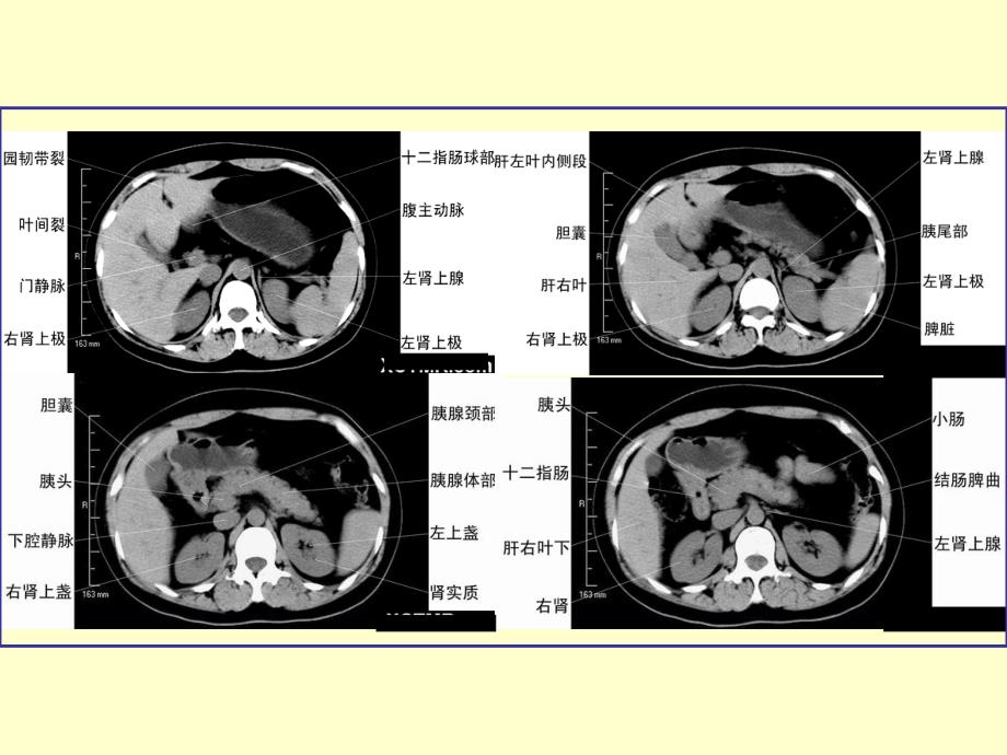 胰腺肿瘤病变的影像学诊断PPT课件_第4页