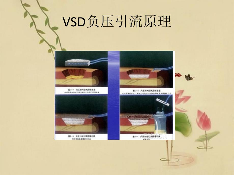 VSD负压引流术后护理PPT课件_第4页