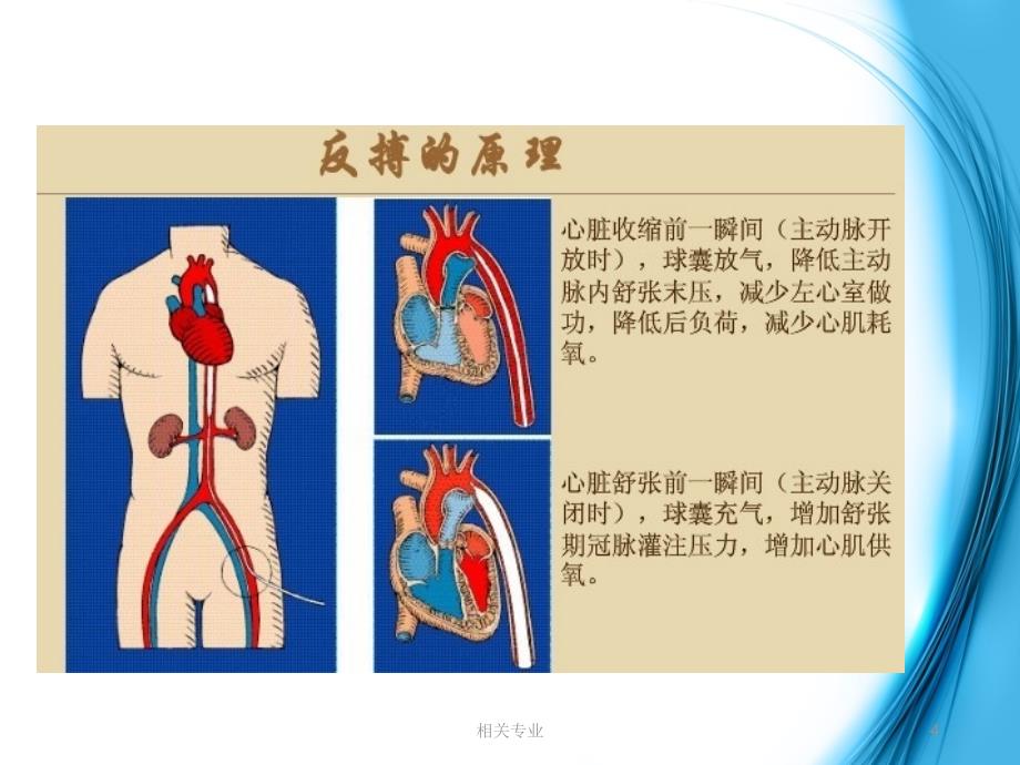 主动脉球囊反搏术护理【研究荟萃】_第4页