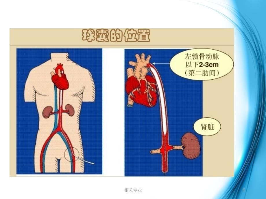 主动脉球囊反搏术护理【研究荟萃】_第5页