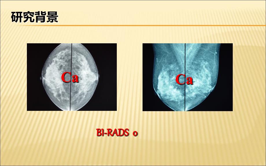 【医药健康】外周血测定基因表达差异区分钼BIRADS_第4页