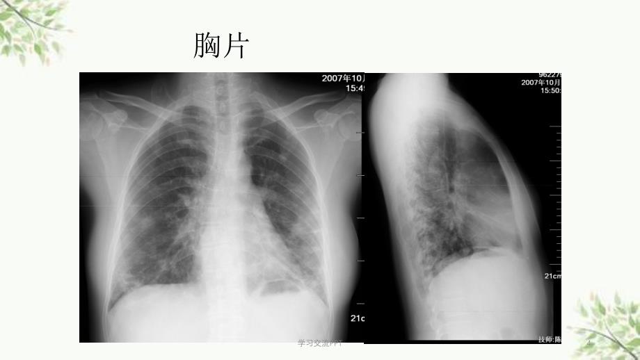 隐源性机化性肺炎.课件_第4页