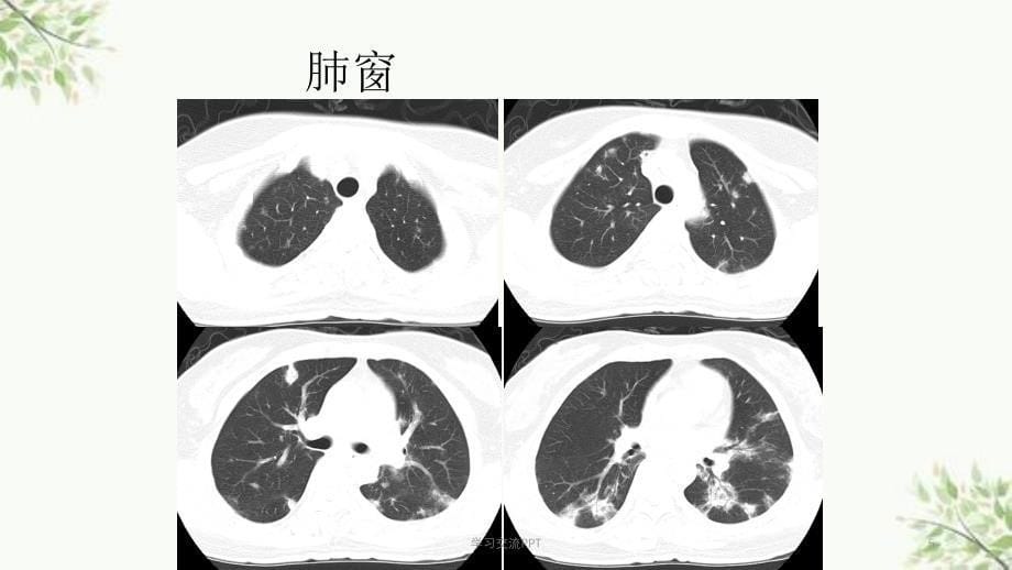 隐源性机化性肺炎.课件_第5页