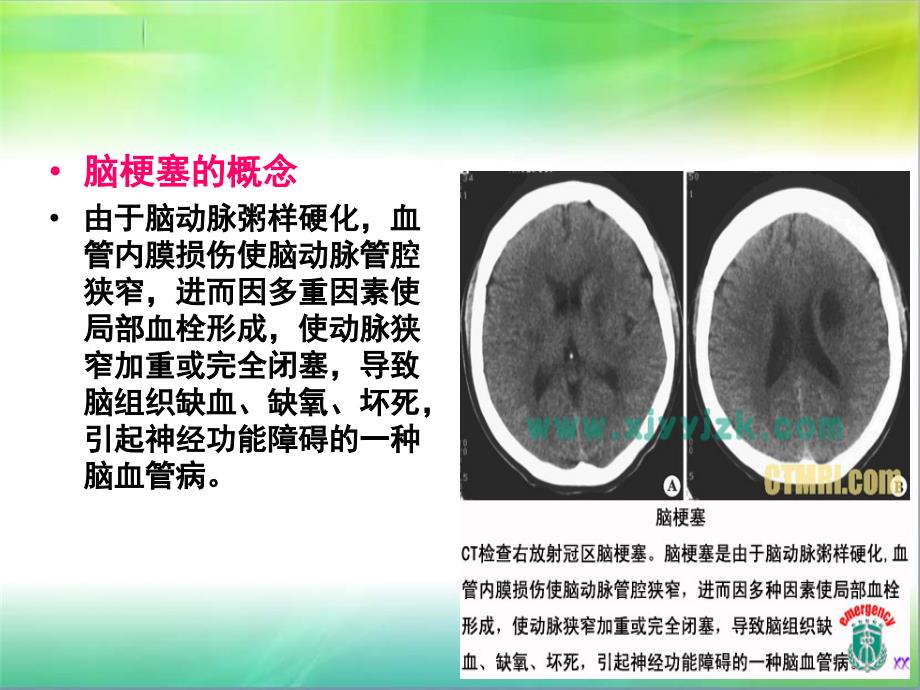 脑梗塞患者护理教学查房PPT通用课件_第4页