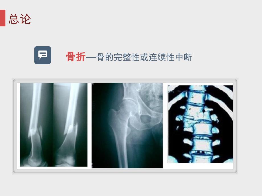 骨折的固定及搬运课件_第3页