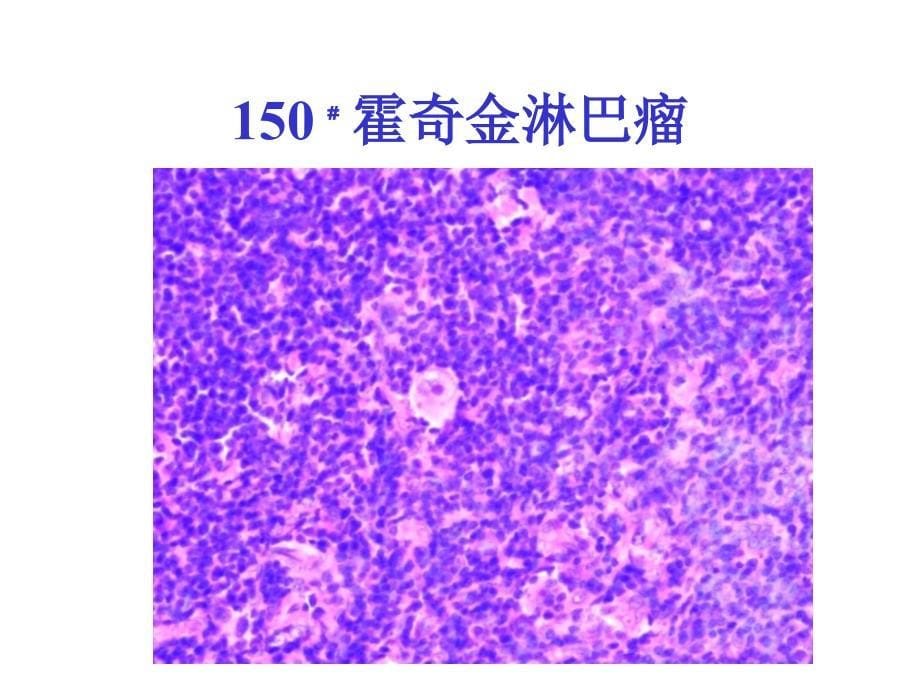 病理学1淋巴造血系统疾病_第5页