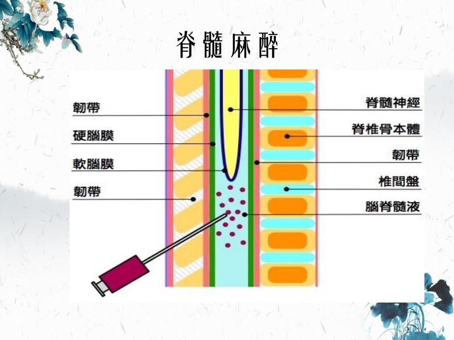 半身麻醉与常见药物介绍_第2页