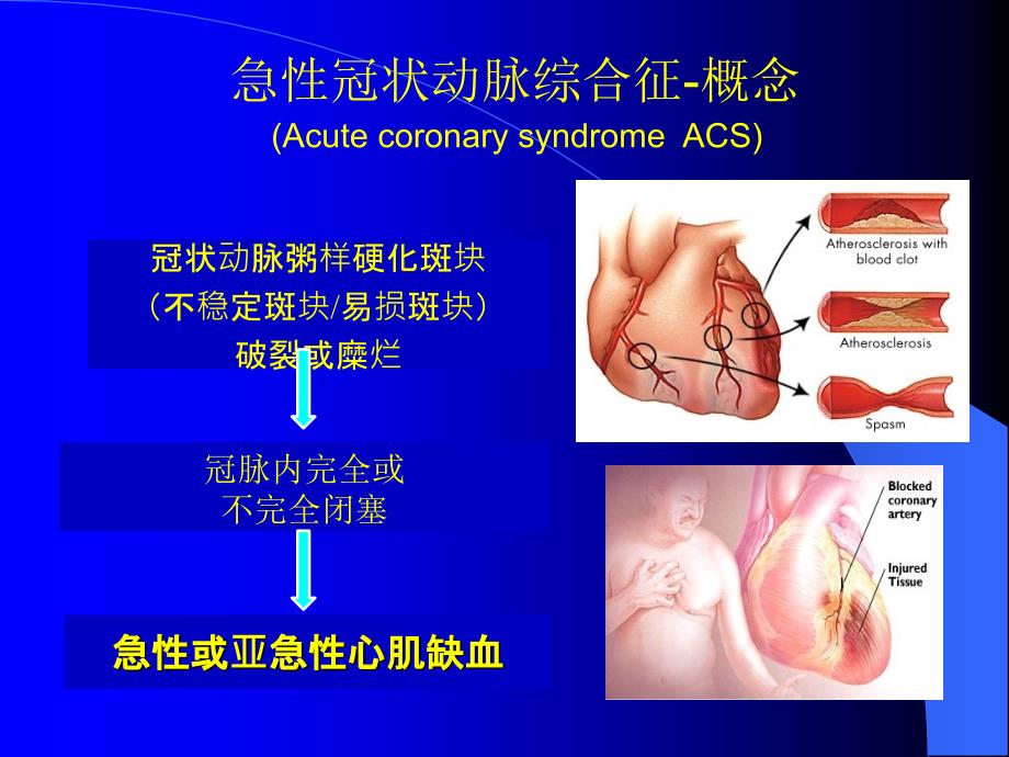 ACS危险分层和处理策略课件_第4页