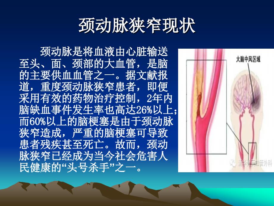 颈动脉狭窄支架介入治疗_第3页