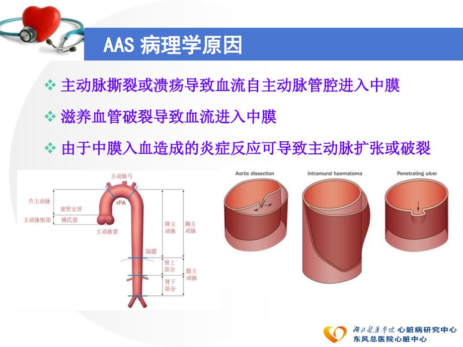 急性主动脉综合征_第3页