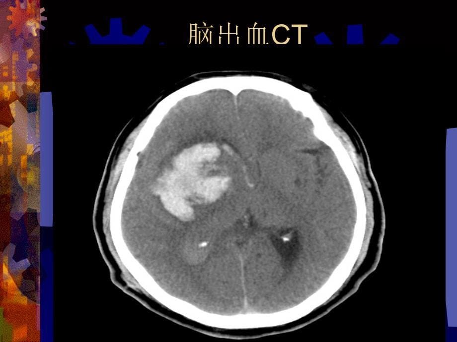 脑出血的影像诊断_第5页