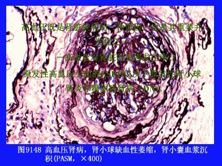 高血压与肾损害_第3页