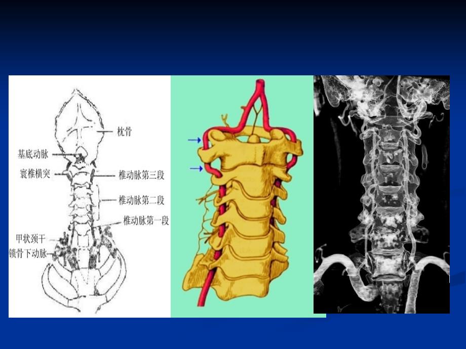 椎基底动脉病变及其临床_第4页