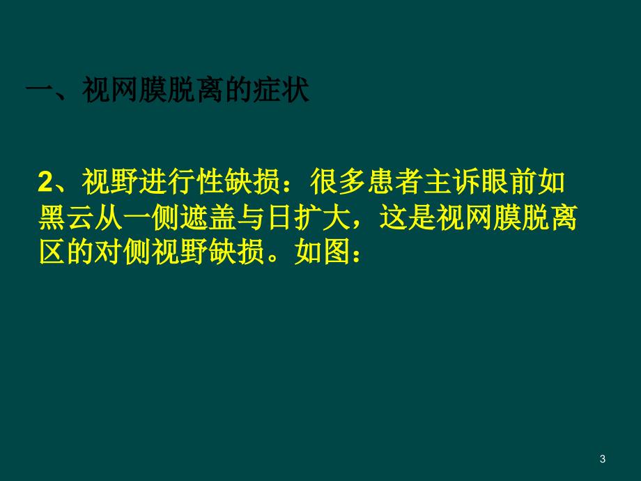 视网膜脱离ppt课件_第3页