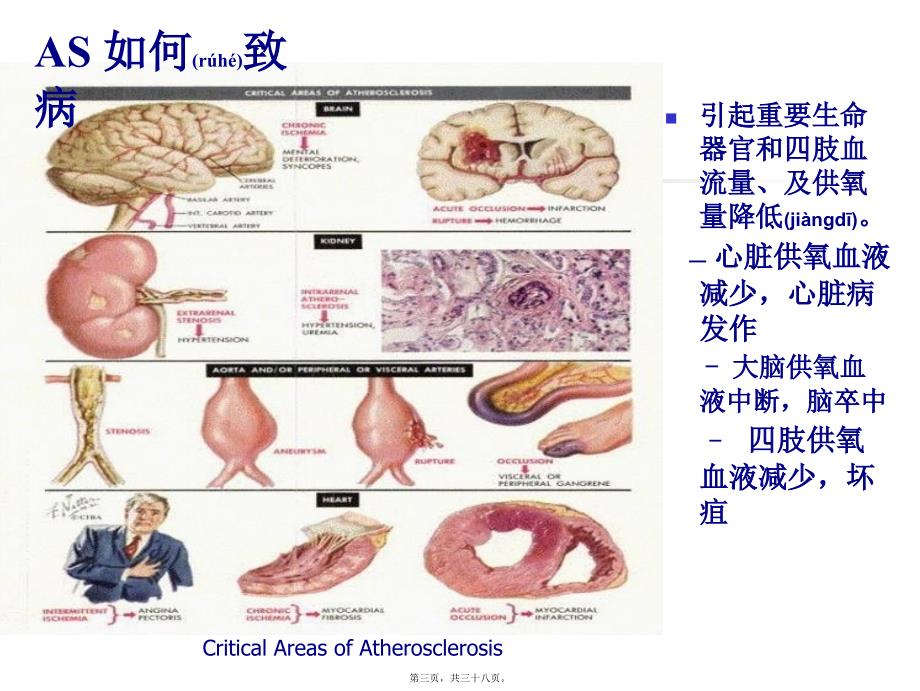 医学专题—抗动脉粥样硬化药16325_第3页