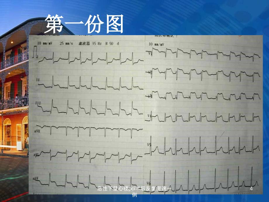 急性下壁心梗pci术后反复室速一例课件_第4页