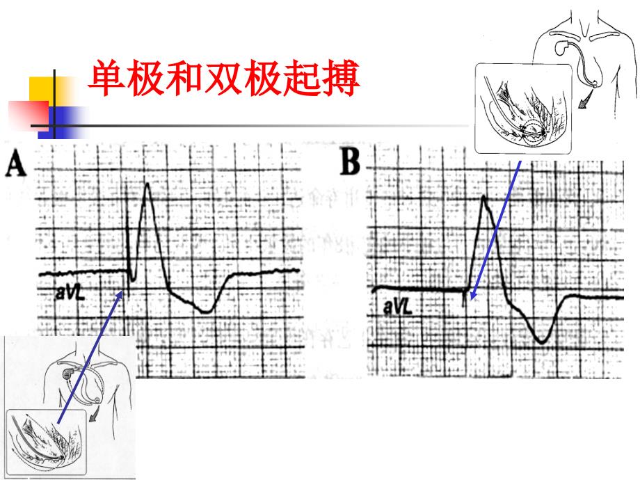 《起搏心电图基础》PPT课件_第4页