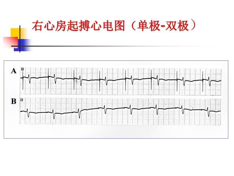 《起搏心电图基础》PPT课件_第5页