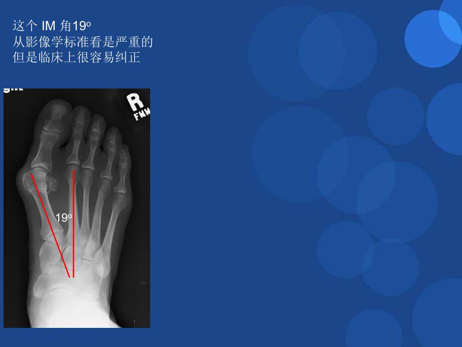 严重拇外翻ppt参考课件_第4页