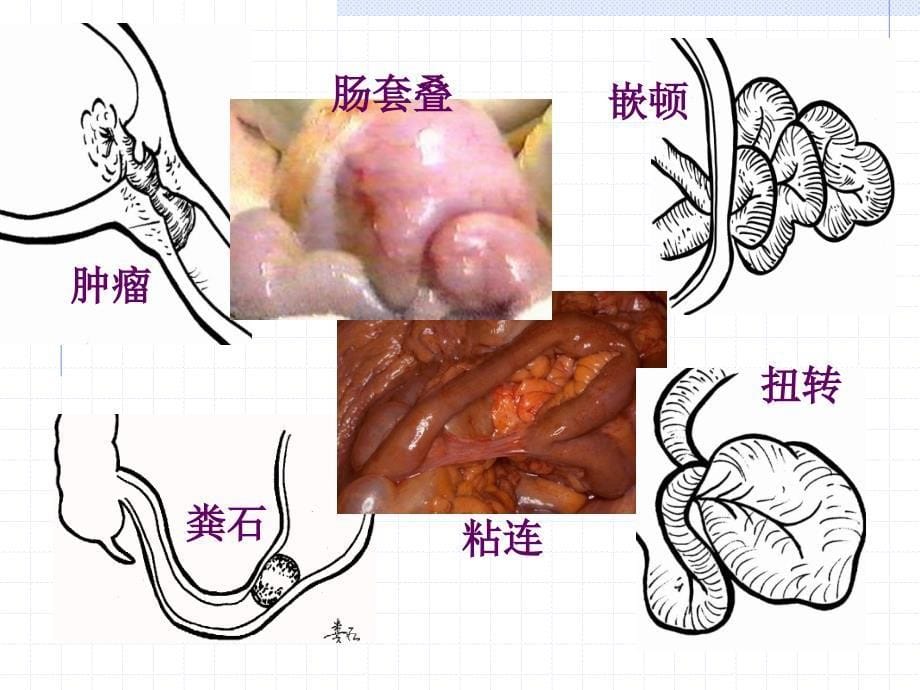 肠梗阻病人的护理PPTPPT课件_第5页