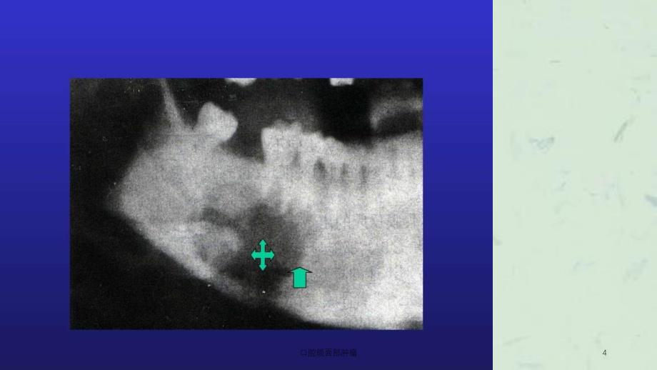 口腔颌面部肿瘤课件_第4页