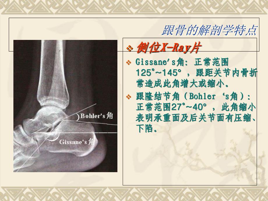 跟骨骨折分型及治疗_第3页